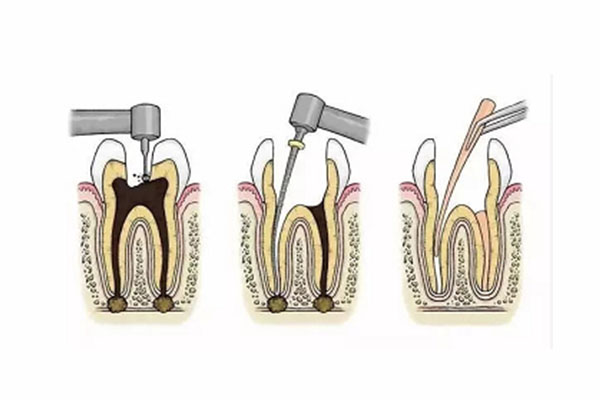 补牙洞用的根管是什么东西(补牙洞用