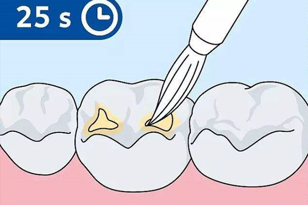 牙齿涂氟要多久时间(牙齿涂氟要多久