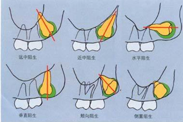 长智齿把口腔戳破了怎么办(长智齿把