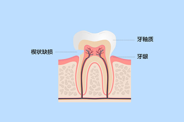 牙齿楔状缺损治疗(牙齿楔状缺损治疗