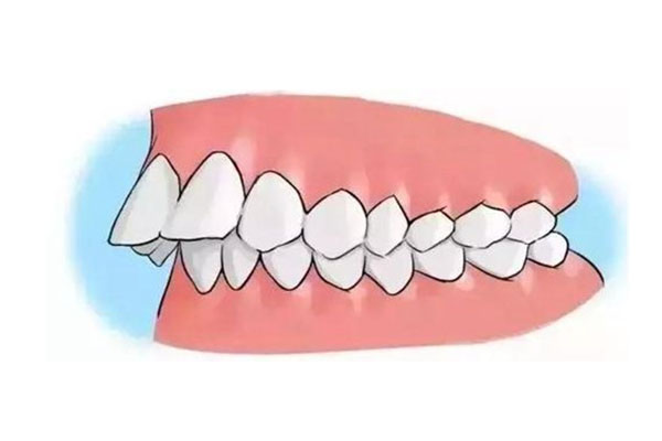 牙齿有点天包地正常吗(牙齿天包地怎
