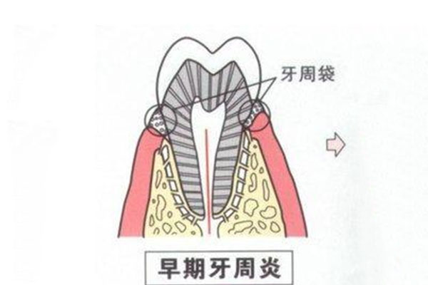 慢性牙周炎患者主诉症状通常为(慢性