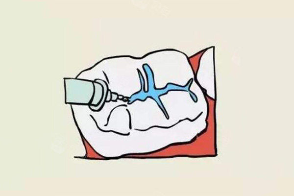 小朋友牙齿涂氟几岁开始