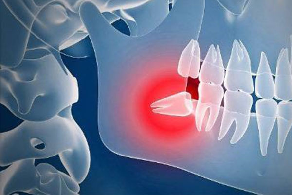 智齿冠周炎治疗(智齿冠周炎治疗要多