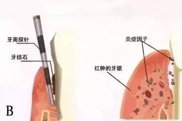 根管治疗后 牙齿寿命(根管治疗后牙齿