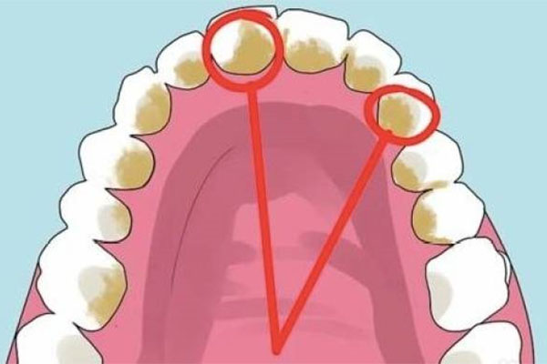 牙齿有黄垢是什么原因引起的(牙齿有