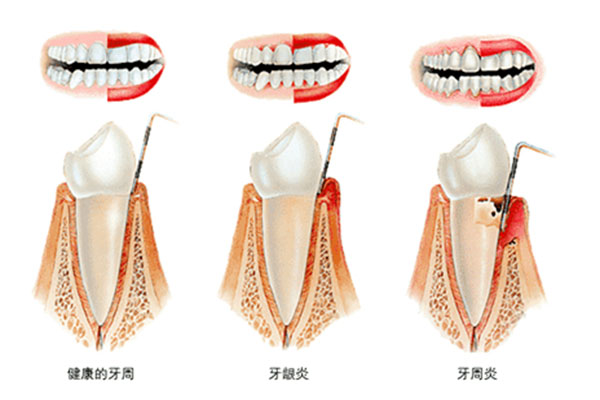 如何判断是牙周炎还是牙根炎(如何判断是牙周炎还是牙根炎图片