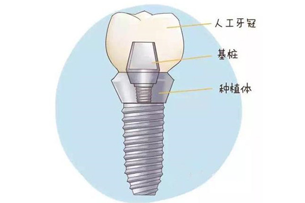 种牙医院哪儿医院好(种牙医院哪儿医院好一点)