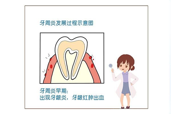 什么是牙周炎,如何治疗