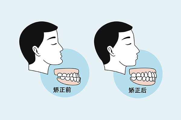 牙齿矫正变成了天包地(牙齿矫正了还是天包地)