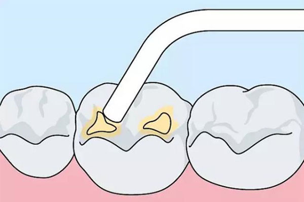 窝沟封闭材料有哪些,哪个好(窝沟封闭的材料对身体有害吗)