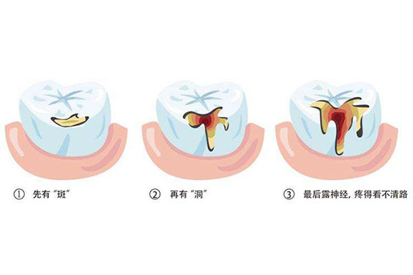 补牙填充材料后要烫一下(补牙填充材