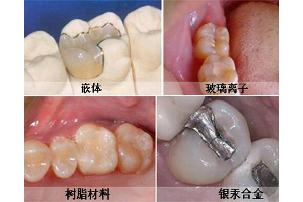 牙医补牙用的什么材料做的(牙科补牙