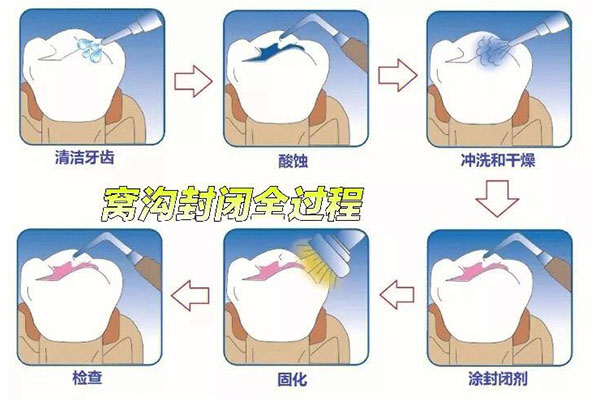 宝宝牙齿涂氟费用(给宝宝牙齿涂氟的价格)