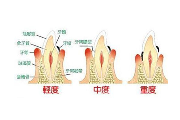 宝宝蛀牙疼痛难忍怎么办吃什么药(宝宝蛀牙疼痛难忍怎么办吃什