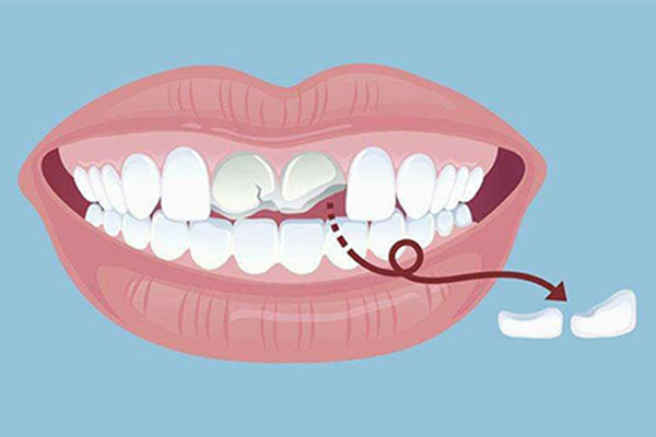 刷牙缺损怎么治疗