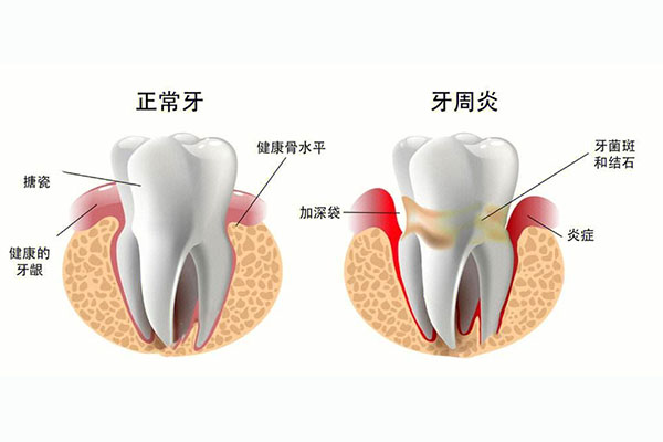 牙龈炎牙周病吃什么药(牙龈炎牙周炎吃什么药)