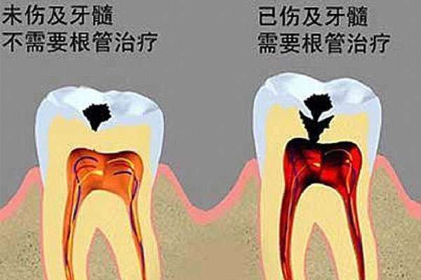 什么叫牙齿根管治疗疼不疼呀(什么叫牙齿根管治疗疼不疼呀视频