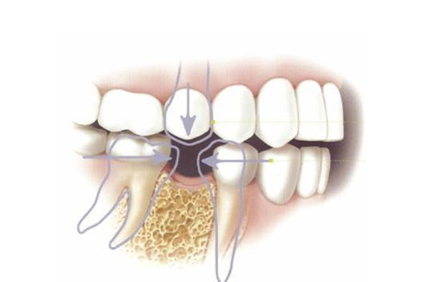 牙结石自行脱落的原因是什么(牙结石自行脱落的原因是什么呢