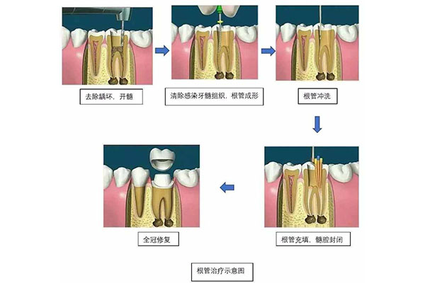 龋坏到牙龈以下能做根管吗(龋坏到牙龈以下能做根管吗多少钱