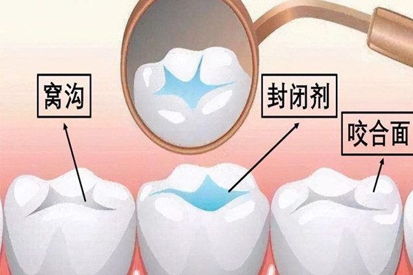 儿童牙齿有必要涂氟吗(儿童牙齿有必要涂氟吗图片)