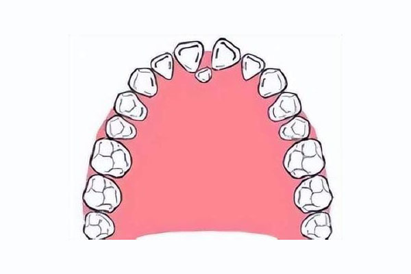 后槽牙旁边有个小牙齿是什么意思(后槽牙旁边有个小牙齿是什么