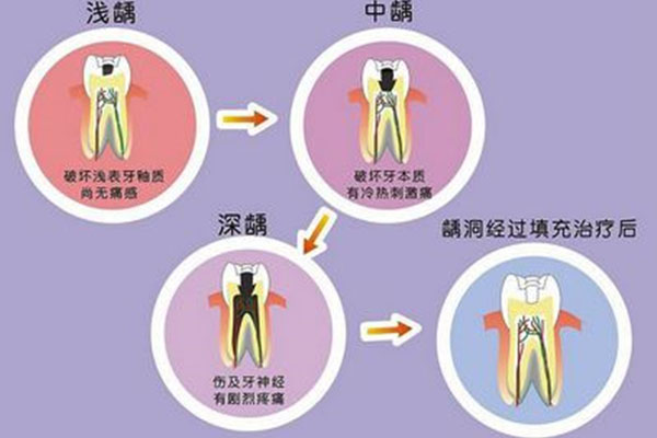 如果有一点点蛀牙了一定要去医院吗多少钱(如果有一点点蛀牙了