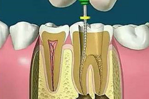 做了根管治疗戴了牙套一年后牙疼怎么办(做了根管治疗戴了牙套