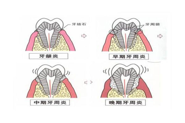 牙周病嘴巴会臭吗为什么(牙周病嘴巴会臭吗为什么不能吃辣)