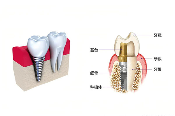 牙齿脱落除了种牙还有其他方法吗(牙齿脱落除了种牙还有其他方