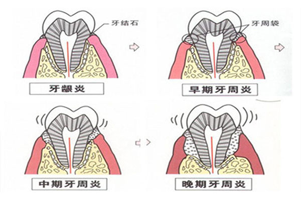 牙周病不可逆吗(牙周病不能根治吗)