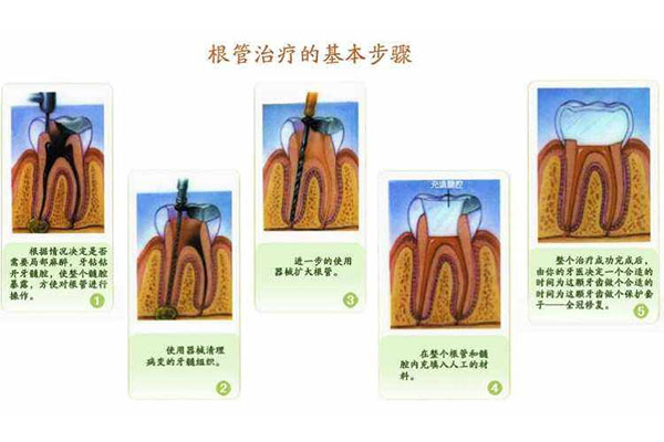 根管治疗公费医疗可以报销吗(根管治疗公费医疗可以报销吗)