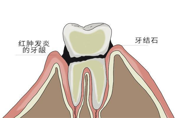 牙黄黑是什么原因造成的怎么治疗(牙黄黑是什么原因造成的怎么