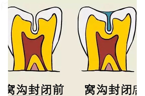 儿童窝沟封闭几颗牙需要做牙冠吗(儿童窝沟封闭几颗牙需要做牙