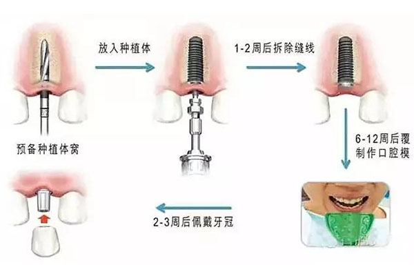 60岁以后种牙好不好(60岁以后种牙好不好呀)