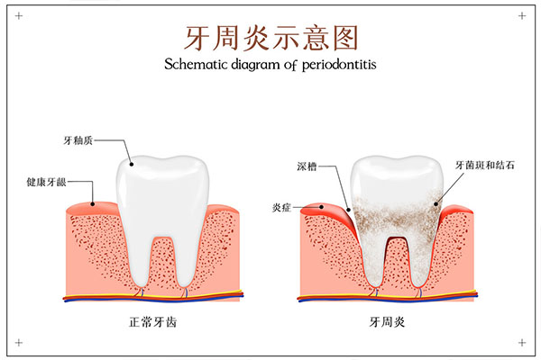 牙周炎是什么症状吃什么药好(牙周炎