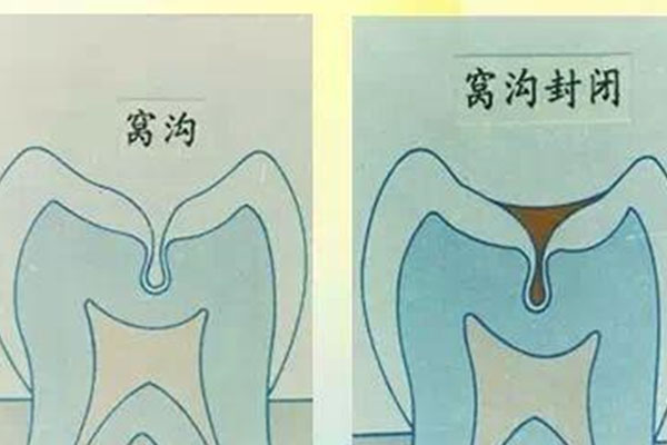 口腔科涂氟操作流程(口腔科涂氟操作流程图)