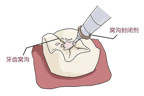 封牙齿窝沟疼吗多久能好转呢(封牙齿