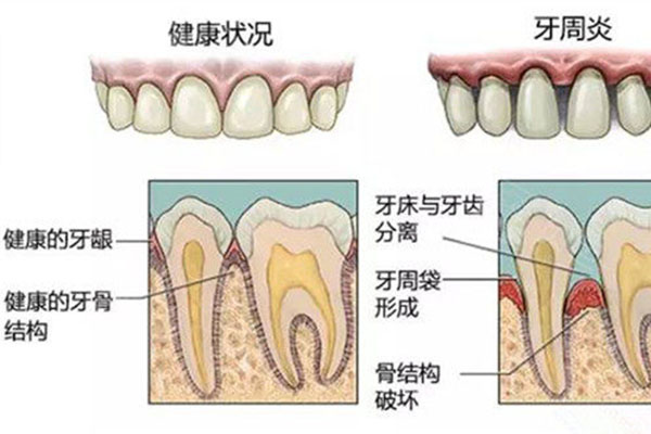 牙周治疗是什么原理(牙周治疗是啥