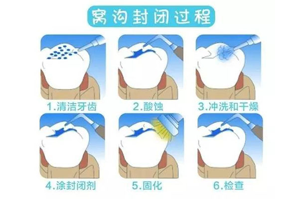 牙齿涂氟对人体有哪些危害(牙齿涂氟