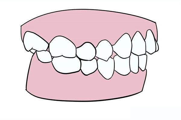 28岁地包天牙齿还能矫正过来吗(28岁地