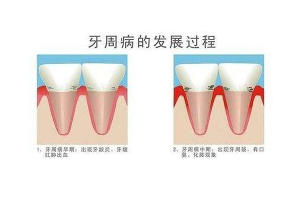 牙周炎快速止痛小妙招(牙周炎快速止痛小妙招有哪些)