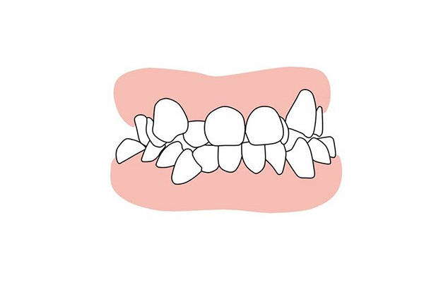 牙齿不齐可不可以做烤瓷牙矫正呢(牙