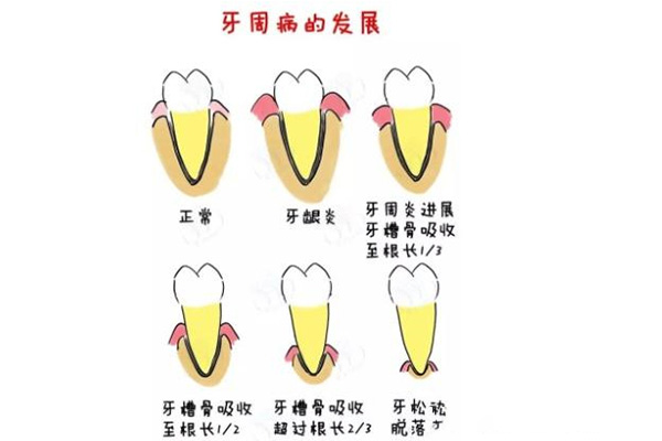 轻微牙周炎治疗后,会让牙缝慢慢变小