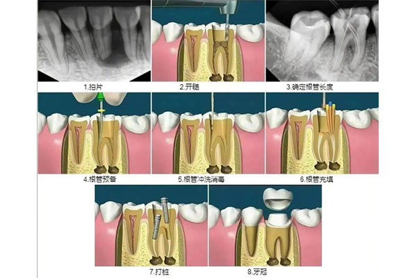 根管治疗怎么做不疼(根管治疗怎么做