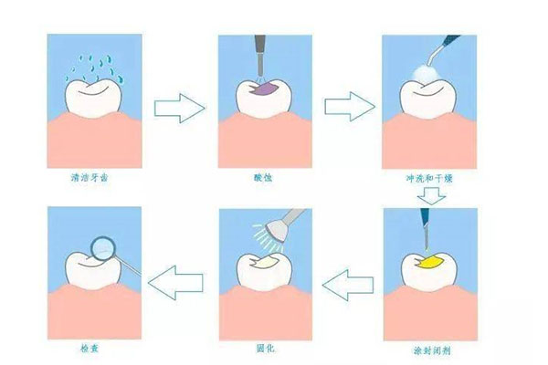 窝沟封闭 操作流程(窝沟封闭操作流程