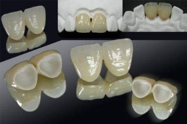 3d烤瓷牙多少钱一颗(300元1颗的烤瓷牙图片)