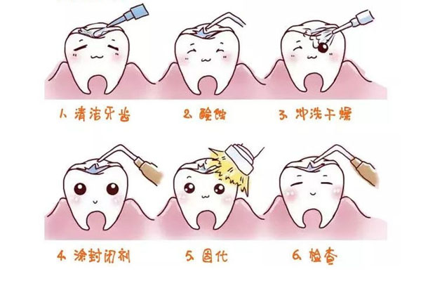 成人牙齿涂氟多久一次(成人牙齿涂氟多久一次比较好)