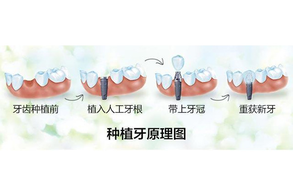 2020种牙多少钱一颗啊价格(2020种牙多