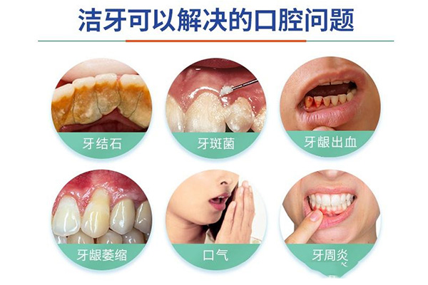 ems洗牙和超声波洗牙的区别